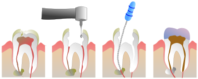 Endodonzia